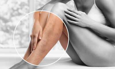 Cuidados Pós-Cirurgia de Varizes: Orientações Essenciais para uma Recuperação Bem-Sucedida