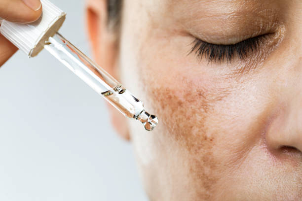 Melasma facial: Desvendando as manchas escuras da pele e encontrando a colução